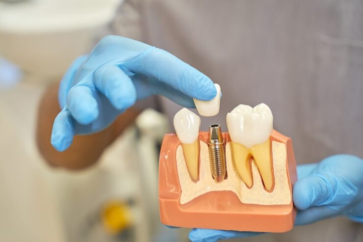 Implantes Dentales Santiago Precio: Lo Que Nadie Te Dice Antes de Cotizar